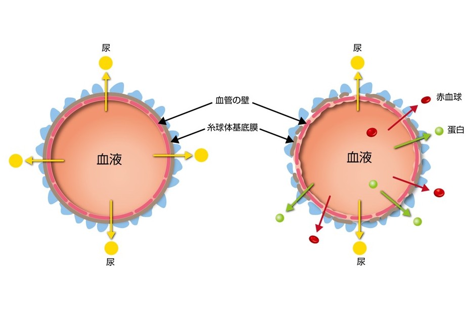 糸球体の中の血管について正常な血管とアルポート症候群の血管の比較画像